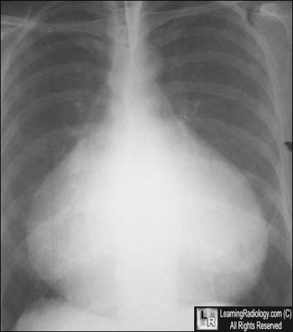 Pericardial effusion